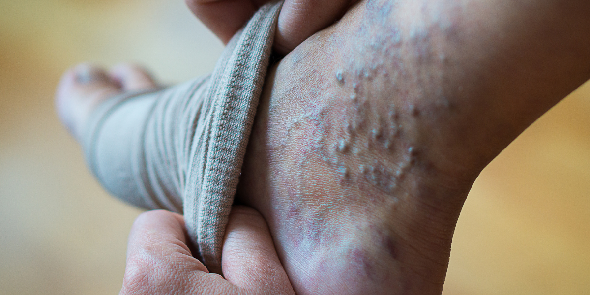 Exploring Varicose and Spider Veins: What Sets Them Apart