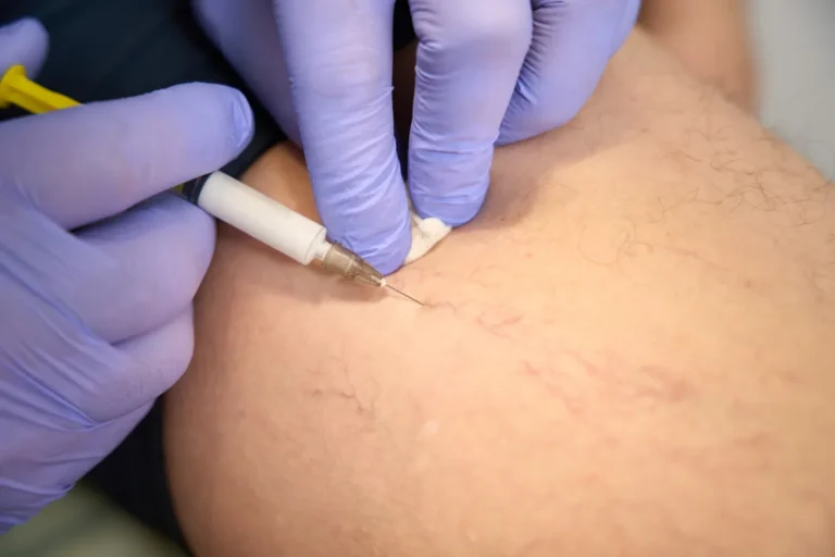 Sclerotherapy injection treating spider veins on a leg